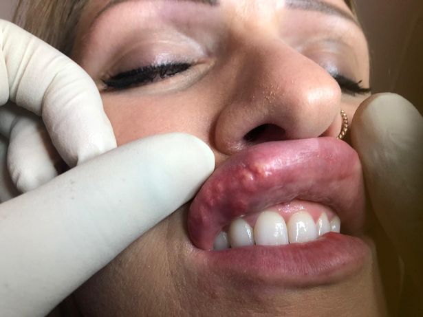 Lips and teath with fingers in gloves around to show harms of lip fillers