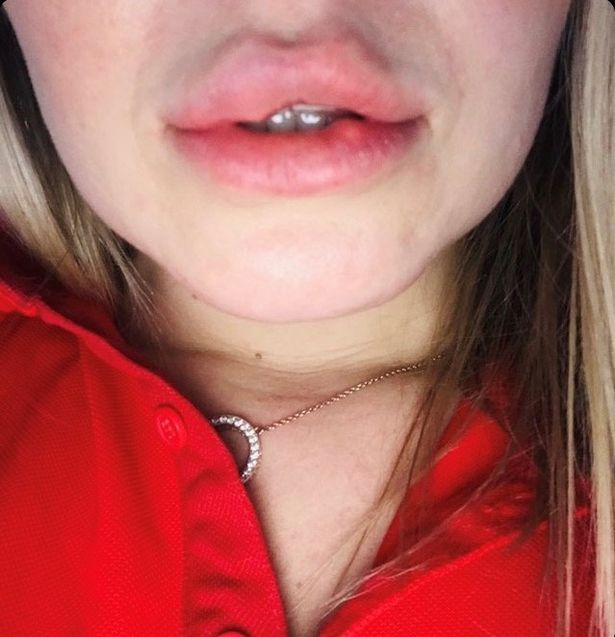 face and lips of a woman showing harms of lip fillers